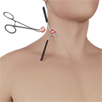 Cyst Excision