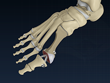 Metatarsophalangeal Joint Fusion