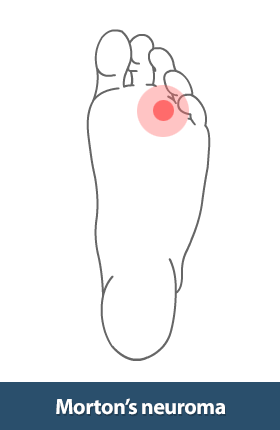 Morton’s Neuroma Excision